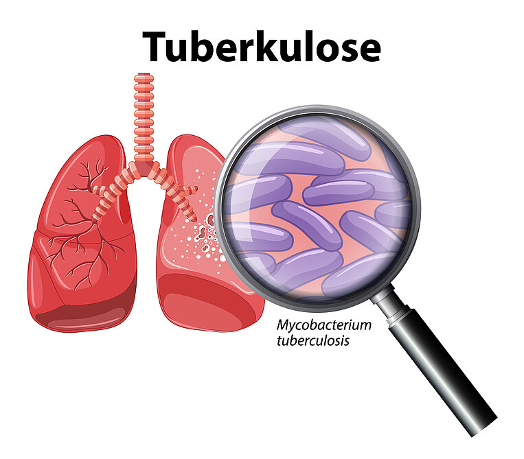 Tuberkulose Heilung natürlich unterstützen